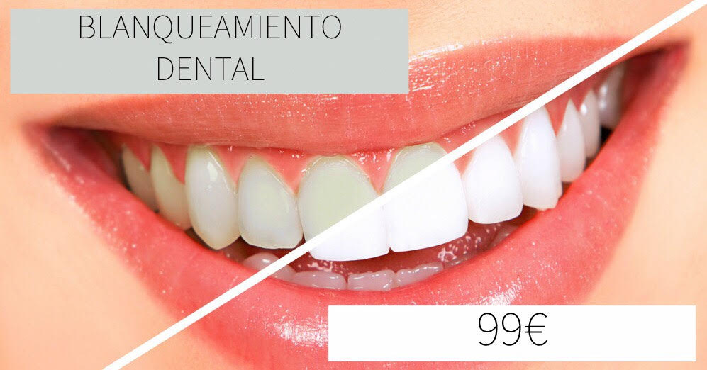 dientes blancos - DS Iconic Beauty - Aesthetic Medicine - Albir